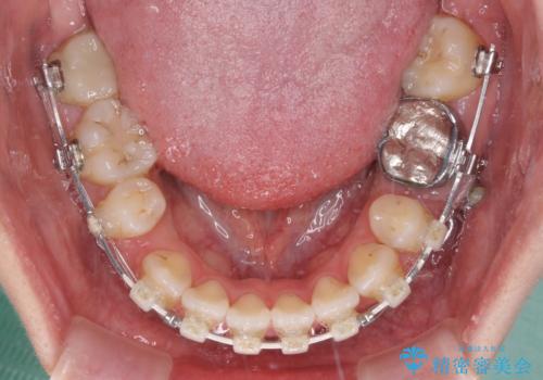八重歯と開咬を治したい 目立たないハーフリンガル矯正の治療中