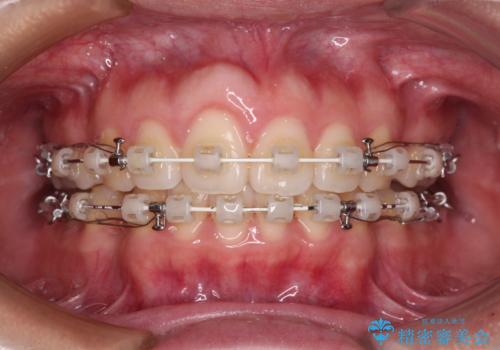 前歯の出っ歯と口の閉じにくさが気になる　目立たないワイヤー装置での抜歯矯正の治療中