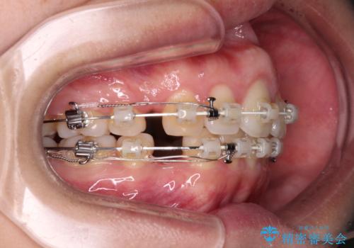 前歯の出っ歯と口の閉じにくさが気になる 目立たないワイヤー装置での抜歯矯正の治療中
