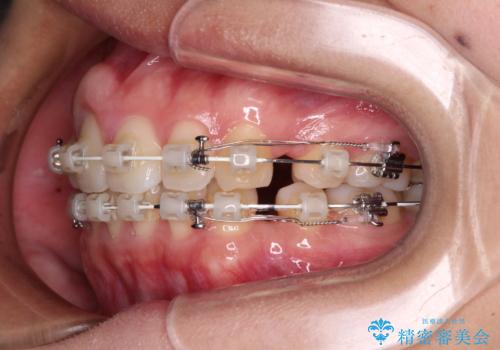 前歯の出っ歯と口の閉じにくさが気になる 目立たないワイヤー装置での抜歯矯正の治療中