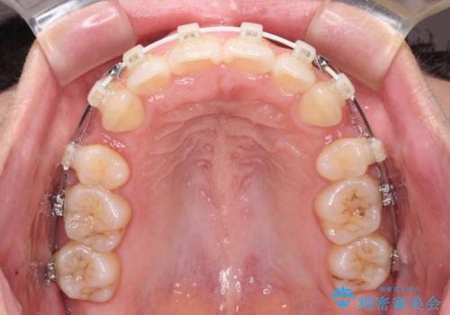 前歯の出っ歯と口の閉じにくさが気になる 目立たないワイヤー装置での抜歯矯正の治療中