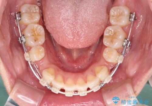 前歯の出っ歯と口の閉じにくさが気になる　目立たないワイヤー装置での抜歯矯正の治療中