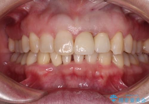 前歯のインプラント治療　折角なので矯正治療できれいな歯並びにの治療中