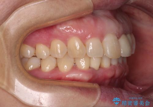 前歯のインプラント治療　折角なので矯正治療できれいな歯並びにの治療中