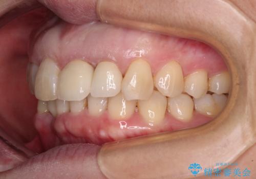 前歯のインプラント治療　折角なので矯正治療できれいな歯並びにの治療中