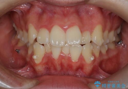 【インビザライン】前歯の凸凹を非抜歯で治療の治療中