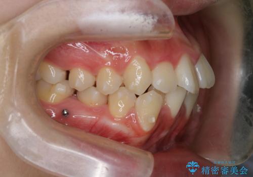 【インビザライン】前歯の凸凹を非抜歯で治療の治療中