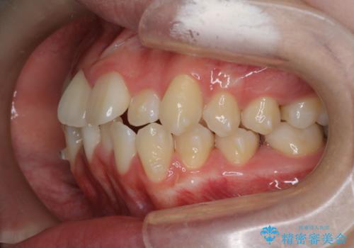 【インビザライン】前歯の凸凹を非抜歯で治療の治療中
