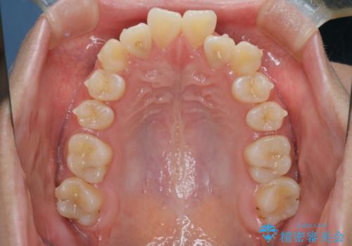 【インビザライン】前歯の凸凹を非抜歯で治療の治療中