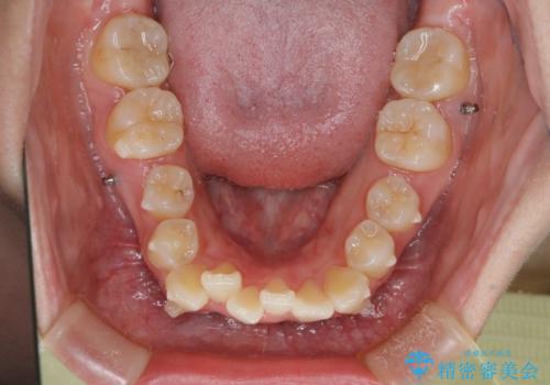 【インビザライン】前歯の凸凹を非抜歯で治療の治療中