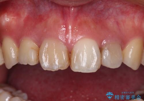 八重歯と開咬を治したい 目立たないハーフリンガル矯正の治療中