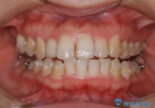 インビザラインをつけたままお茶やコーヒーを飲んで着色