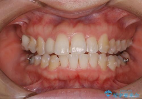 インビザラインをつけたままお茶やコーヒーを飲んで着色の症例 治療後