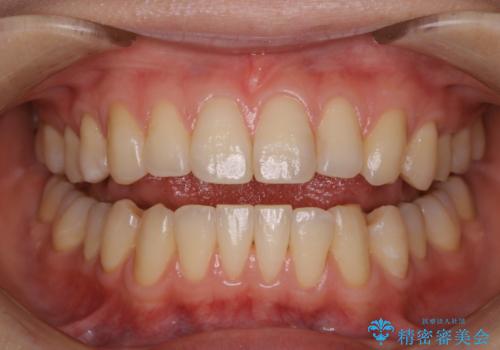 3ヶ月メンテナンス時に一緒にPMTCも行えます!の症例 治療後