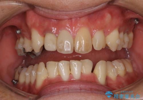 半年ぶりのクリーニング(インビザラインの矯正中)