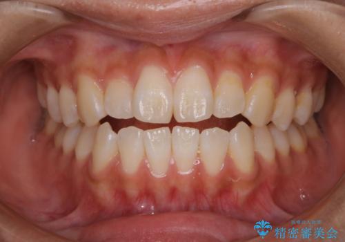 オフィスホワイトニングのエクセレントコース