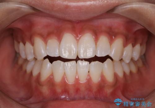 オフィスホワイトニングのエクセレントコースの症例 治療後