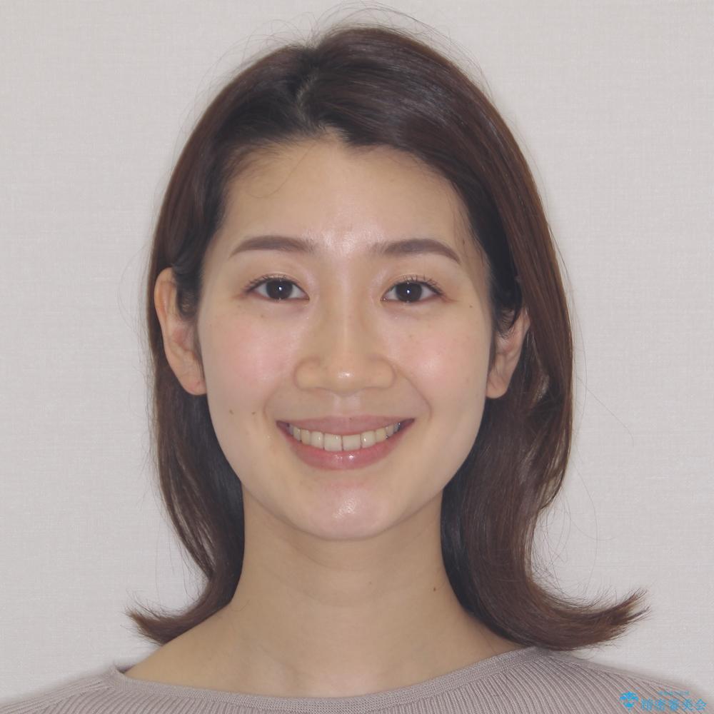 【モニター】飛び出した上顎前歯のワイヤー矯正で改善の治療後(顔貌)
