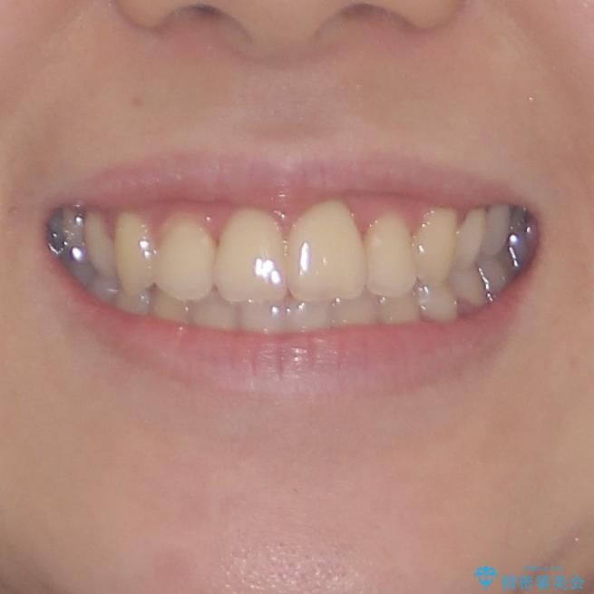 前歯のクロスバイトを短期間で解消　目立たないワイヤー矯正の治療後（顔貌）