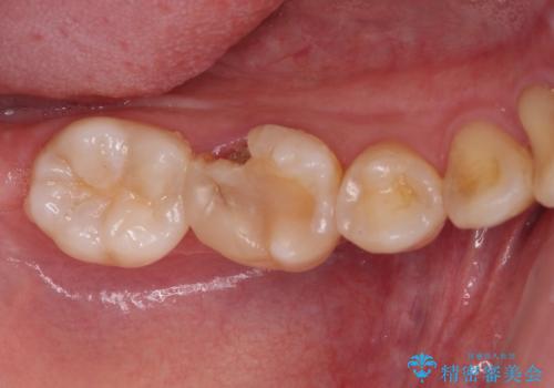 歯が欠けてしみる　オールセラミッククラウンによる虫歯治療の症例 治療前