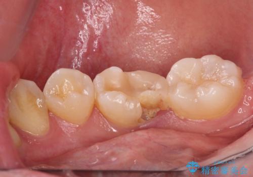歯が欠けてしみる オールセラミッククラウンによる虫歯治療の治療前