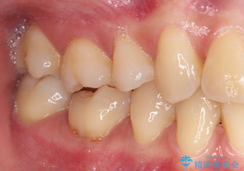 歯が欠けてしみる オールセラミッククラウンによる虫歯治療の治療前