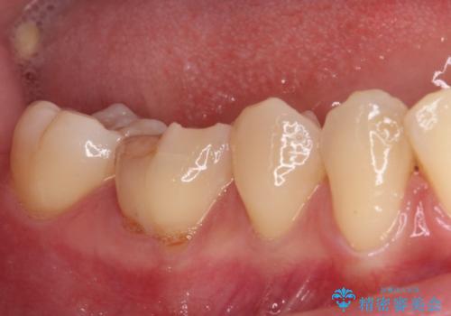 歯が欠けてしみる　オールセラミッククラウンによる虫歯治療の治療前
