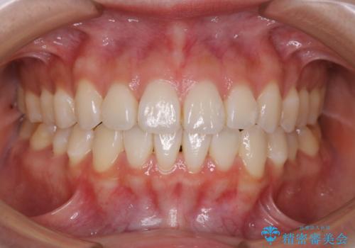 前歯で噛めない:オープンバイト(開咬)を非抜歯インビザラインで治療の治療後