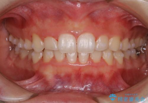 全体的にプラーク(歯垢)付着の患者様(PMTC30分コース)の症例 治療後