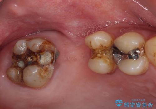 放置した奥歯の虫歯　セラミックブリッジによる補綴治療の症例 治療前
