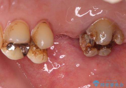 放置した奥歯の虫歯 セラミックブリッジによる補綴治療の治療前
