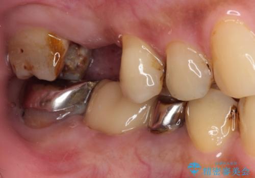 放置した奥歯の虫歯 セラミックブリッジによる補綴治療の治療前