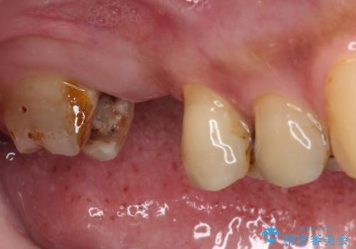 放置した奥歯の虫歯　セラミックブリッジによる補綴治療の治療前