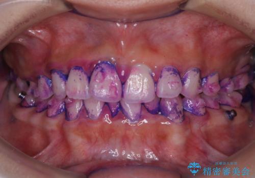 インビザライン中の方へブラッシング指導の治療前