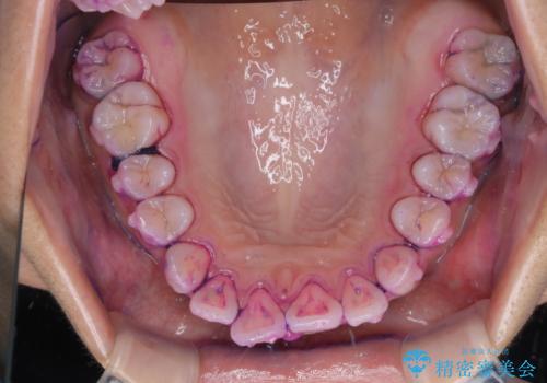 インビザライン中の方へブラッシング指導の治療前
