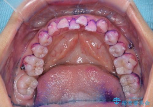 インビザライン中の方へブラッシング指導の治療前