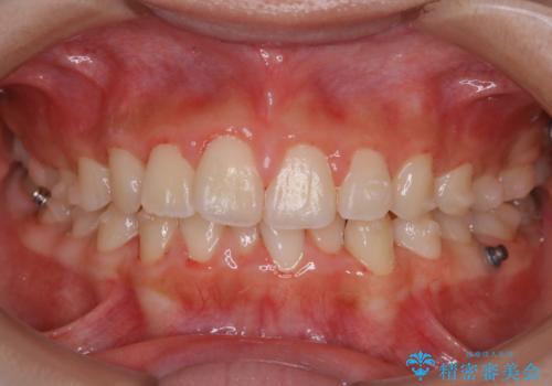 インビザライン中の方へブラッシング指導の治療後