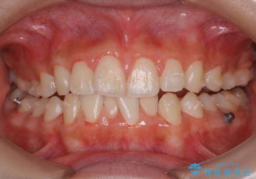 インビザライン中の方へブラッシング指導の治療後