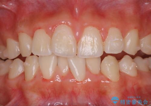 インビザライン中の方へブラッシング指導の治療後