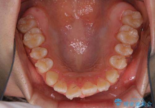 インビザライン中の方へブラッシング指導の治療後