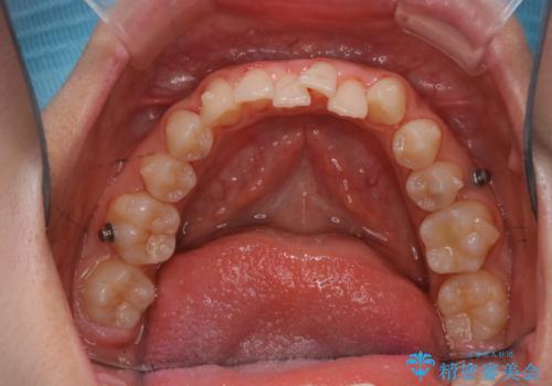 インビザライン中の方へブラッシング指導の治療後