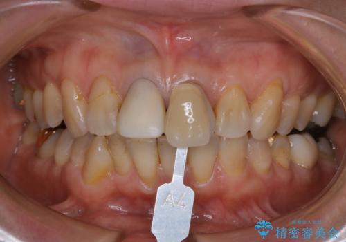 仮歯に合わせてホワイトニングの症例 治療前