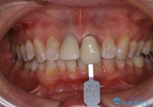 仮歯に合わせてホワイトニングの症例 治療後