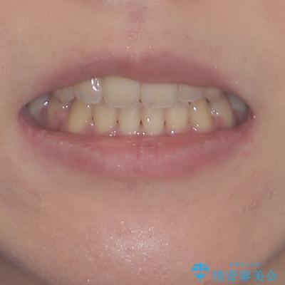 八重歯を抜歯矯正でスッキリと　メタルブラケットでの矯正治療の治療後（顔貌）