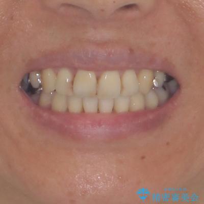 八重歯で口元が膨れている　ワイヤー装置での抜歯矯正の治療後（顔貌）