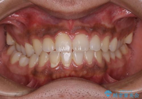 10年ぶりの歯医者、初めてのクリーニングの治療前