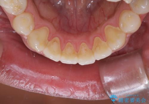 10年ぶりの歯医者、初めてのクリーニングの治療前