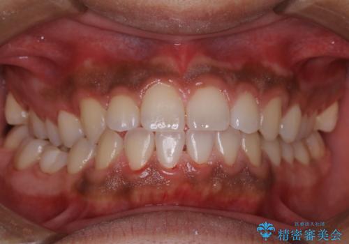 10年ぶりの歯医者、初めてのクリーニングの治療後