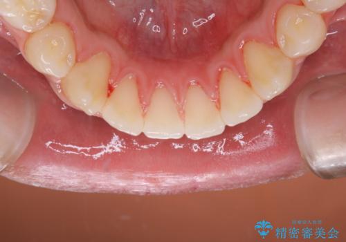 10年ぶりの歯医者、初めてのクリーニングの治療後
