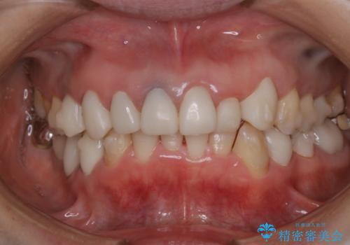 矯正中に患者様で治療と一緒にクリーニング(PMTC30分)の治療後